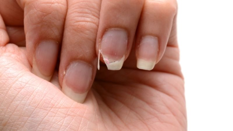 niedobór witamin łamliwe paznokcie